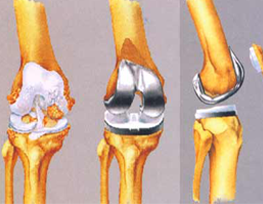 Joint replacement and reconstruction